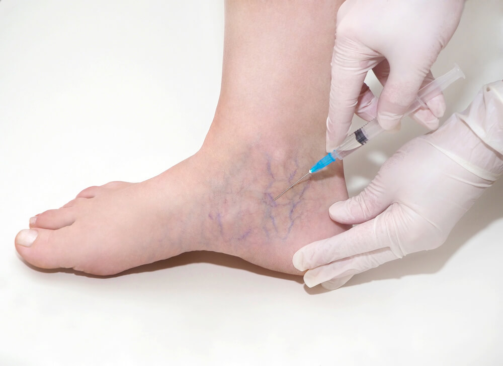 woman receiving sclerotherapy in her foot