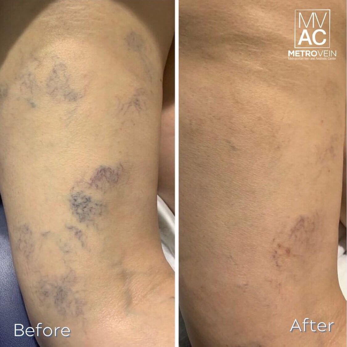 Spider Vein Treatment Before and After