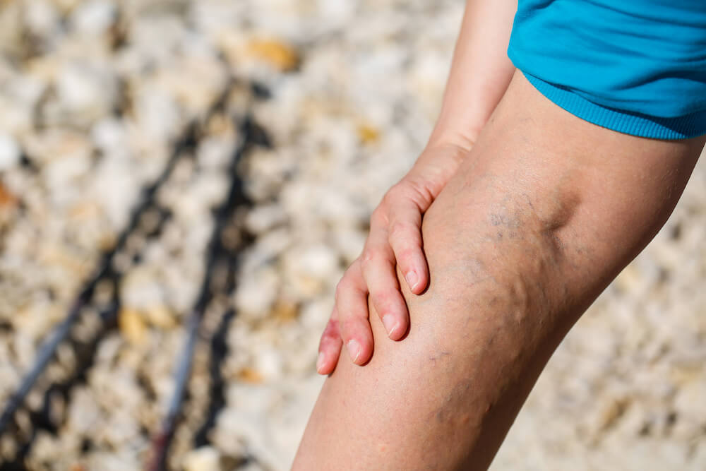 man with varicose veins untreated at the beach