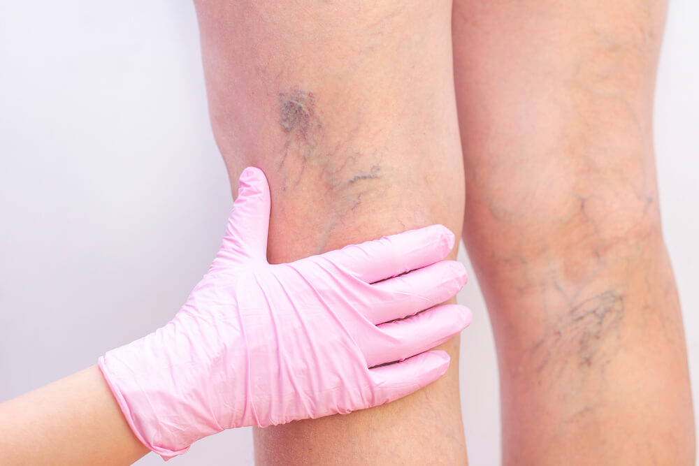 spider veins that turned into varicose veins on the back of a womans leg