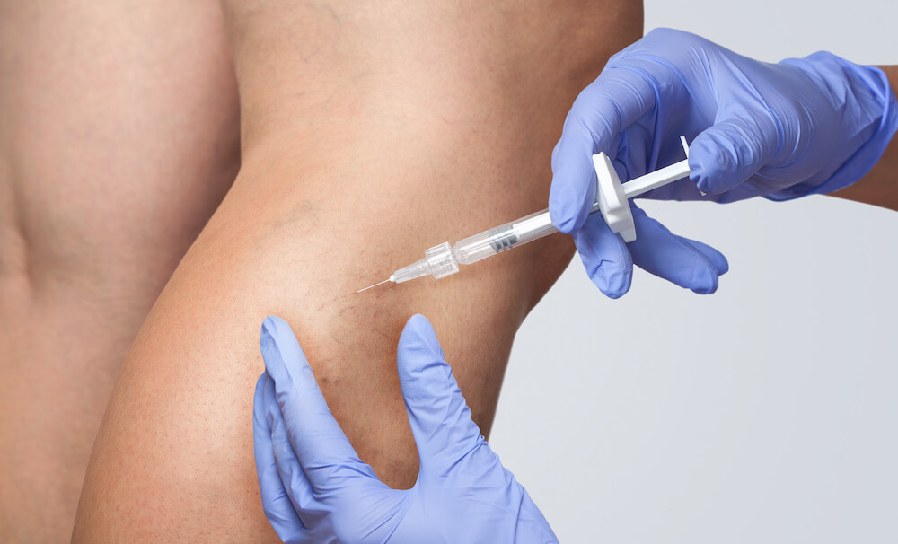 a doctor performing sclerotherapy on varicose veins in new york