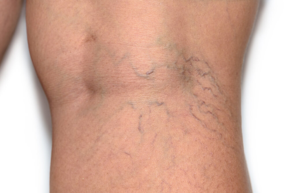 woman with spider veins on the back of her knees on a white background