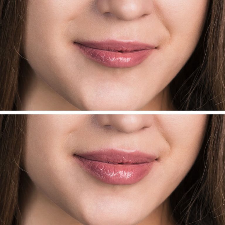 Woman's lips before and after augmentation