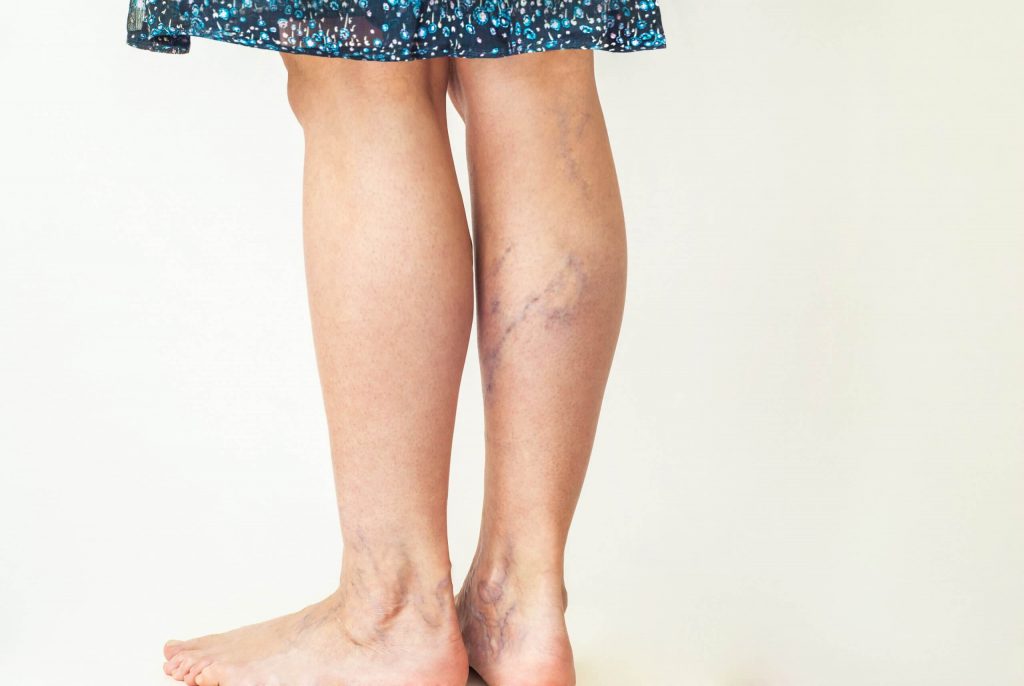 Why Young People Get Varicose Veins and How Best to Treat Them