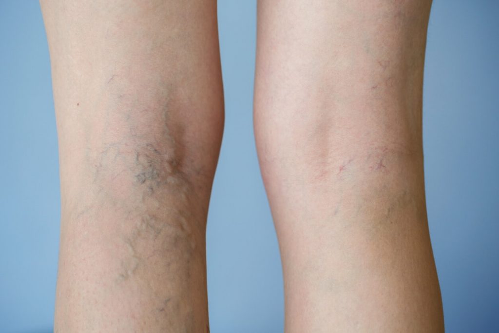 Get rid of those unwanted spider veins with varicose vein removal.