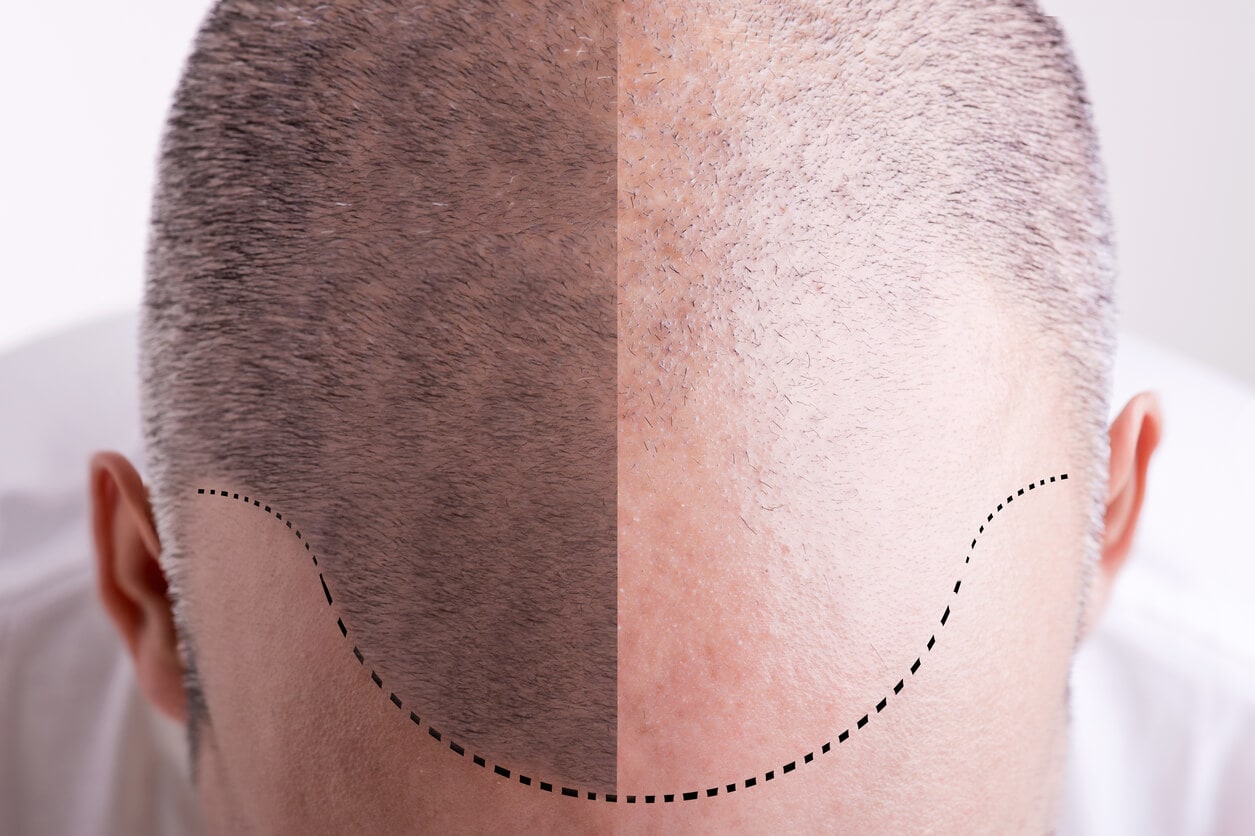 Is a Hair Transplant Your Best Option for Bald Spots? | NY Metro Vein
