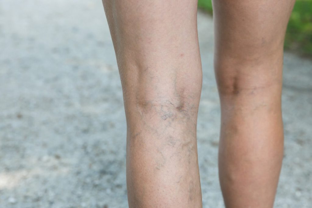 There are a range of temporary and more permanent solutions to deal with your spider veins. One effective solution is sclerotherapy in Yonkers. Learn more.